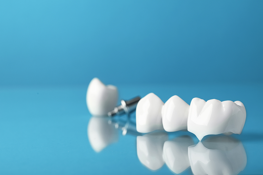 Restoring Your Smile with Crowns and Bridges in Greenbelt, MD