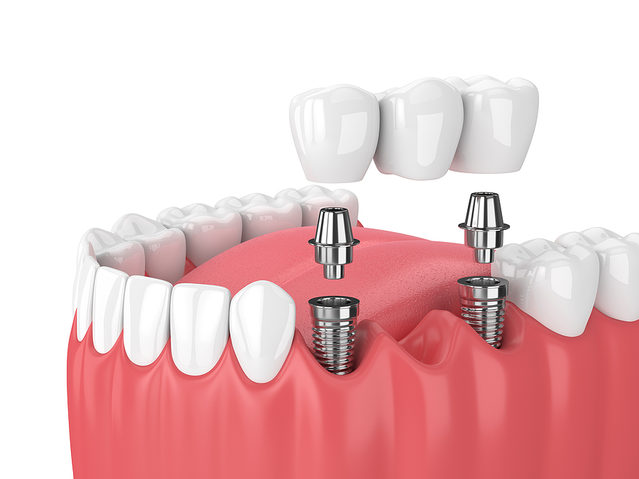 The Ultimate Guide to Dental Implants in Greenbelt, MD