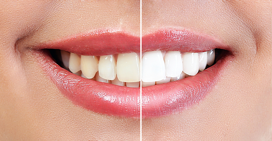 Brighten Your Smile with Professional Teeth Whitening in Greenbelt, MD