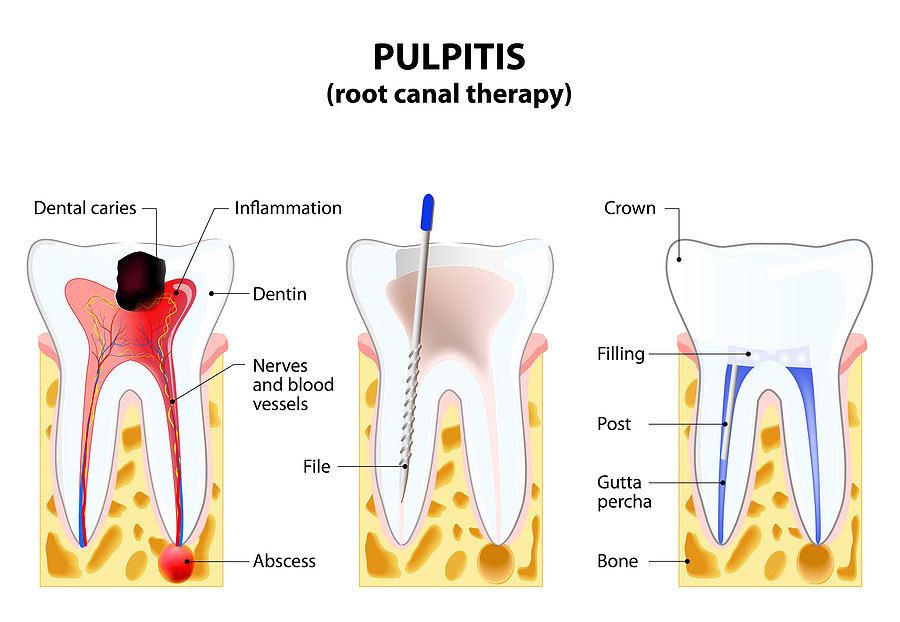 The Importance of Root Canals: Restoring Oral Health and Relieving Pain